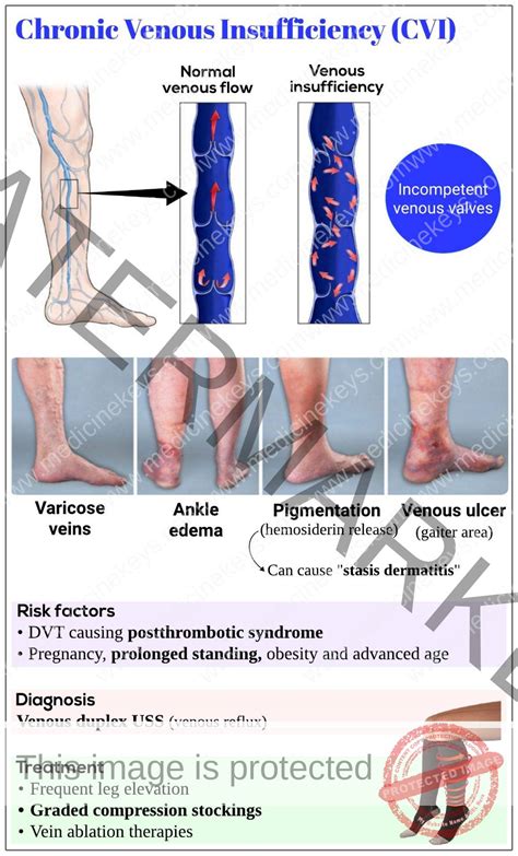 Chronic venous insufficiency (CVI) - Medicine Keys for MRCPs