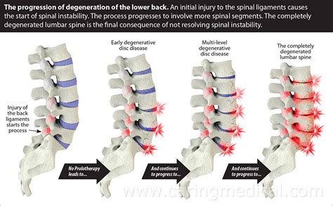 Alternatives to spinal fusion surgery and revision spinal fusion surgery