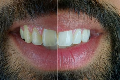 Documenting the Evolution of Bleaching Treatment with Mobile Dental Photography - Styleitaliano.org