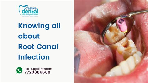 Knowing All About Root Canal Infection