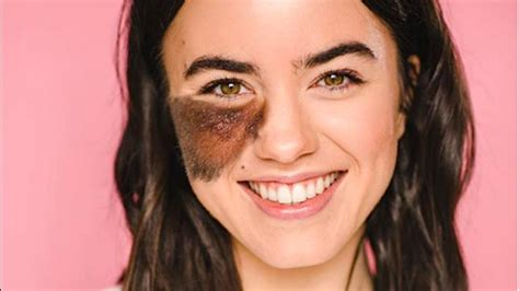 Living with birthmarks: What are the ones you can and cannot remove - CNA