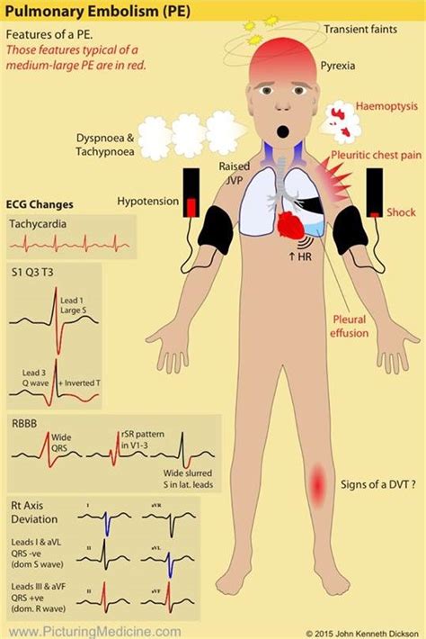 Pulmonary Embolism Causes