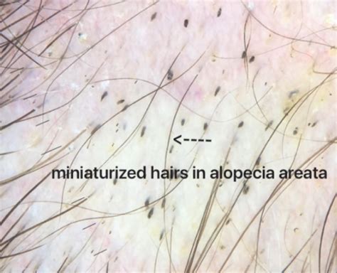 Who said miniaturization only happens in AGA? — Donovan Hair Clinic