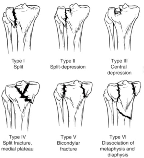 Clasificación de las fracturas de meseta tibial con RX - aware.doctor