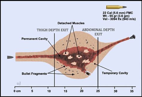 Firearms, bullets, and wound ballistics: An imaging primer - Injury