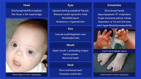 Genetic Epilepsy Syndrome With Classic Dysmorphism, 55% OFF