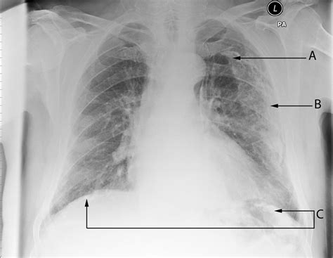 An overview of how asbestos exposure affects the lung | The BMJ