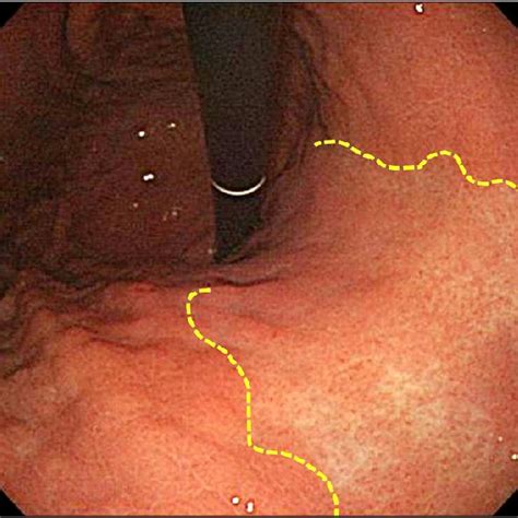 The endoscopic atrophic border (yellow line) in a patient with... | Download Scientific Diagram