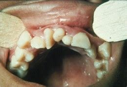 Lesley Paul V.J.'s Blog: Presence of Supernumerary Teeth and its Causes