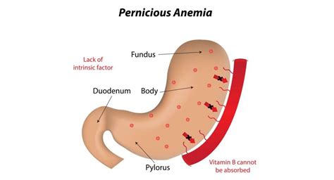 Pernicious Anemia - Dr Sandra Cabot MD