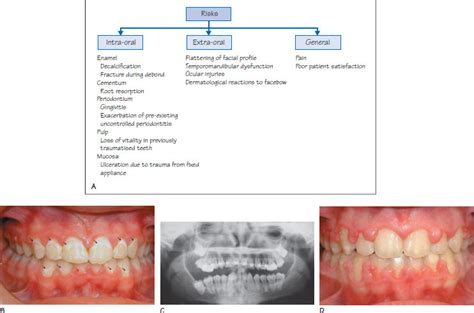 12 Risks and benefits of orthodontic treatment | Pocket Dentistry