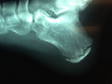 Foot and Ankle Problems By Dr. Richard Blake: Calcaneal Apophysitis ...