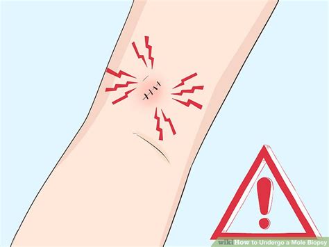 3 Ways to Undergo a Mole Biopsy - wikiHow Health