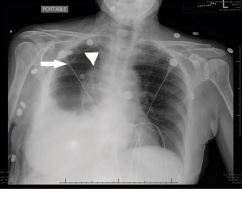 Figure 1 from Pneumothorax ex vacuo in a Patient with Malignant Pleural ...