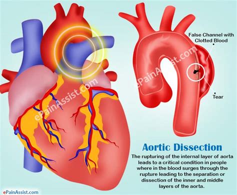 Aortic Dissection|Types|Causes|Symptoms|Treatment|Survival Rate ...