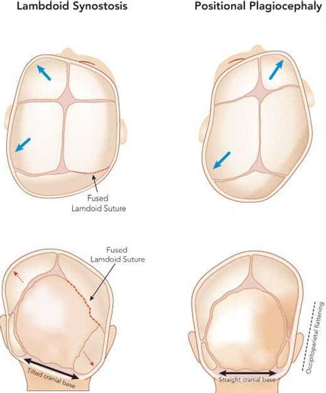 [Figure, Synostotic lamdoid plagiocephaly vs positional plagiocephaly ...