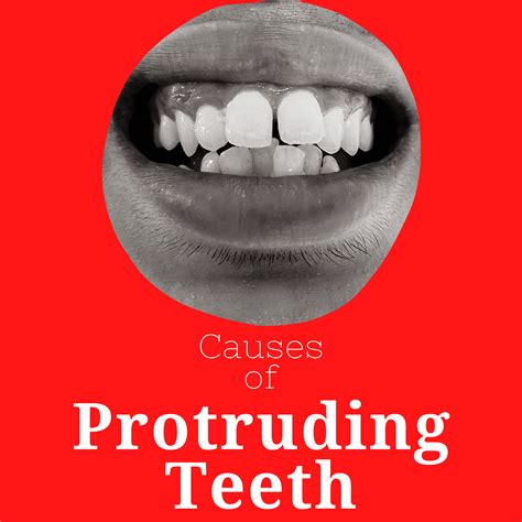 Causes of Protruding Teeth - Children's Happy Teeth