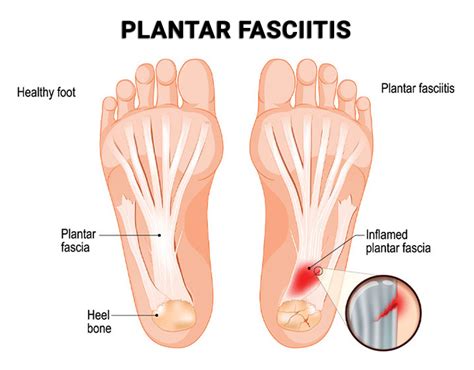 Foot Pain Treatment - Foot Doctors in Clifton, NJ & Wayne, NJ