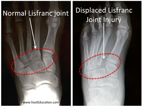 Lisfranc Injury - FootEducation