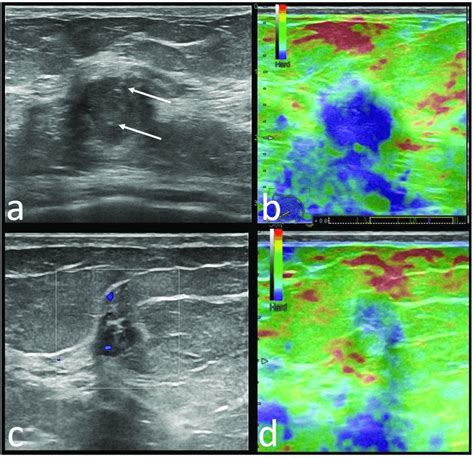 Upper images: 66-year-old ATM mutation carrier patient with right ...