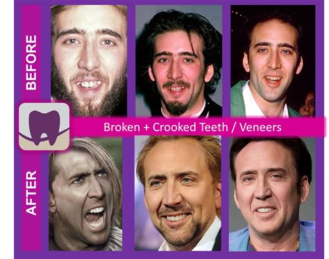 Nicolas Cage Before and After – Stouffville Smiles Dentistry