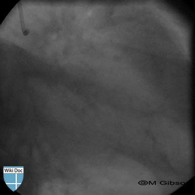 Distal embolization case 9 - wikidoc