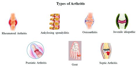 Common types of arthritis reported in the literatures. | Download Scientific Diagram