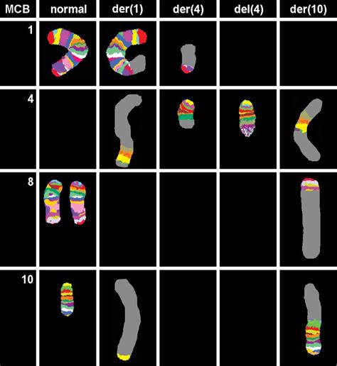 A unique complex translocation involving six different chromosomes in a ...