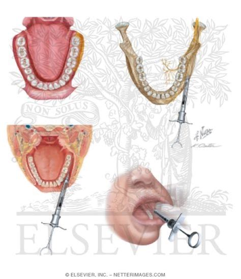 Long Buccal Nerve Block