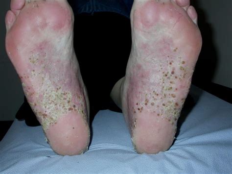 Palmoplantar pustulosis