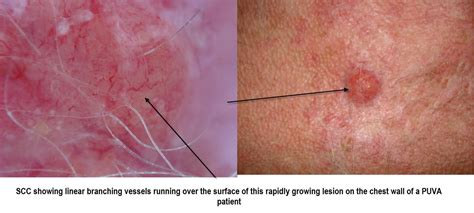 Dermatoscopy Made Simple: SCC invasive