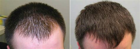 Finasteride Before and After Photos [2023]