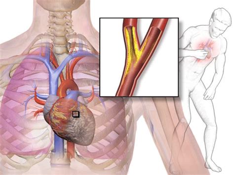 Angina | Valentino Cardiology Specialists