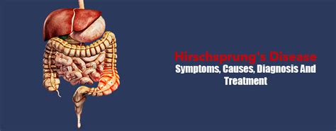 Hirschsprung's Disease- Symptoms, Causes, Diagnosis And Treatment