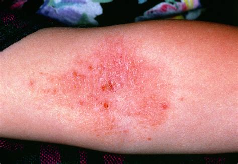 Close-up Of Eczema In The Crook Of The Elbow Photograph by Dr H.c.robinson/science Photo Library ...