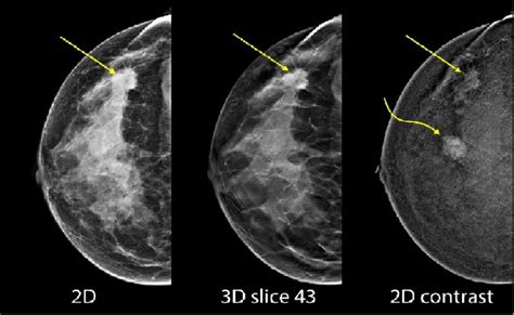 Mammography fusion enhanced by contrast • healthcare-in-europe.com