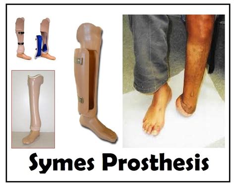 Straight prosthetic foot Chopart Symes Prosthesis (Ankle Disarticulation), For Walking ...