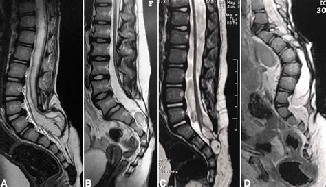 Spina Bifida Mri