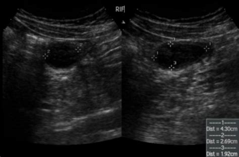 Meckel diverticulitis | Image | Radiopaedia.org