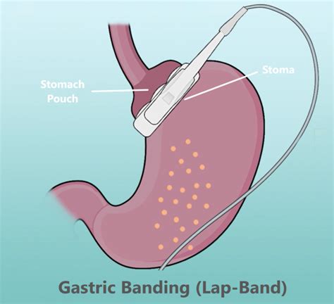 Lap-Band Failure, Removals - Costs, Symptoms, Rates