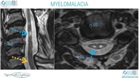 SPONDYLOTIC MYELOPATHY vs MYELOMALACIA: NO MORE CONFUSION - Radedasia