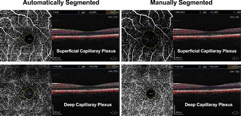 Optical coherence tomography angiography (OCTA) images of the ...