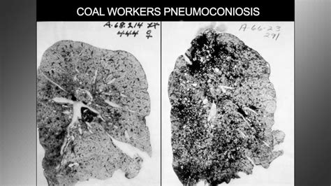 Black Lung Basics: Inside the Miner's Malady - ABC News