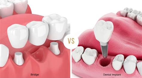 Implant Vs Bridge - Best Image Viajeperu.org