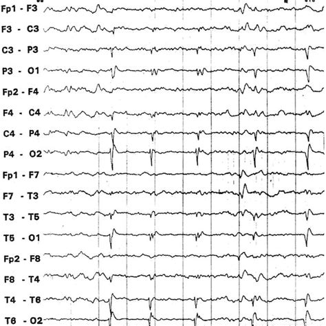 (PDF) The EEG in metabolic encephalopathy and coma