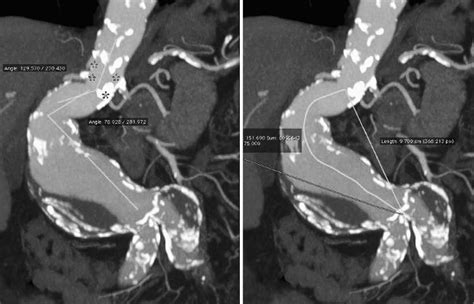 Figure ¤ Preoperative contrast-enhanced computed tomography with... | Download Scientific Diagram