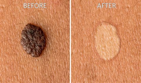 How to get rid of moles: 9 natural home remedies to remove moles from ...