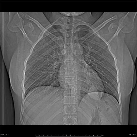 Pulmonary hydatid cyst | Radiology Case | Radiopaedia.org