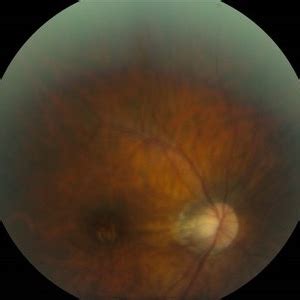 Achromatopsia - Retina Image Bank