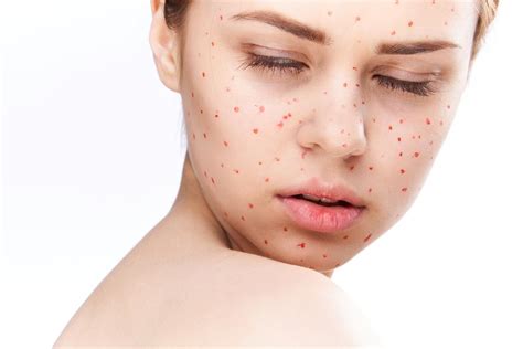 Why Do I Get Red Dots On My Skin After Working Out - Printable Templates Protal